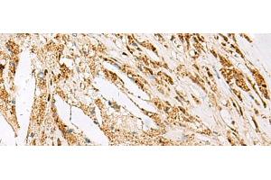 Immunohistochemistry of paraffin-embedded Human thyroid cancer tissue using DNPEP Polyclonal Antibody at dilution of 1:60(x200) (Aspartyl Aminopeptidase Antikörper)