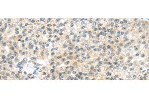 Immunohistochemistry of paraffin-embedded Human breast cancer tissue using TTBK2 Polyclonal Antibody at dilution 1:45 (TTBK2 Antikörper)