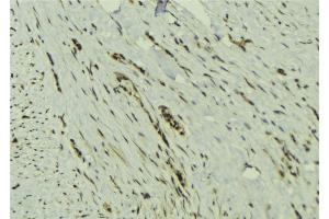ABIN6273132 at 1/100 staining Human breast cancer tissue by IHC-P. (MAD2L2 Antikörper  (Internal Region))