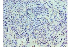 Immunohistochemistry of paraffin-embedded human breast cancer using ABIN7155973 at dilution of 1:100 (HYAL3 Antikörper  (AA 198-417))