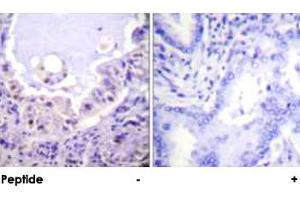 Immunohistochemical analysis of paraffin-embedded human lung carcinoma tissue using RAF1 polyclonal antibody . (RAF1 Antikörper)