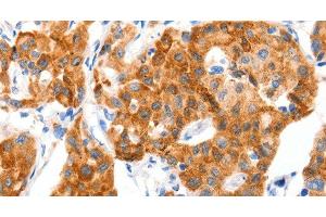 Immunohistochemistry of paraffin-embedded Human lung cancer tissue using GLUT-4 Polyclonal Antibody at dilution 1:70 (GLUT4 Antikörper)