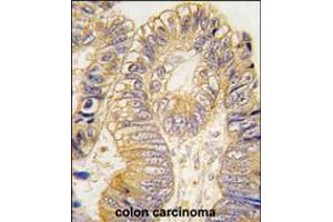 Formalin-fixed and paraffin-embedded human colon carcinoma tissue reacted with CLIC5 antibody , which was peroxidase-conjugated to the secondary antibody, followed by DAB staining.