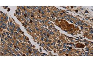 Immunohistochemistry of paraffin-embedded Human lung cancer tissue using PER2 Polyclonal Antibody at dilution 1:50 (PER2 Antikörper)