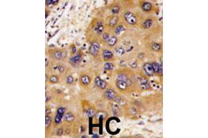 Formalin-fixed and paraffin-embedded human hepatocellular carcinoma tissue reacted with HNMT polyclonal antibody , which was peroxidase-conjugated to the secondary antibody, followed by DAB staining. (HNMT Antikörper  (N-Term))