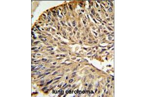 DHFR Antibody IHC analysis in formalin fixed and paraffin embedded human lung carcinoma followed by peroxidase conjugation of the secondary antibody and DAB staining. (Helical Factor Antikörper  (C-Term))