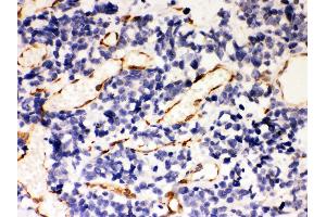 Anti- Hsp47 Picoband antibody, IHC(P) IHC(P): Human Lung Cancer Tissue (SERPINH1 Antikörper  (AA 247-418))