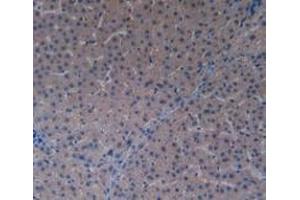 IHC-P analysis of Human Liver Cancer Tissue, with DAB staining. (PAK1 Antikörper  (AA 252-501))