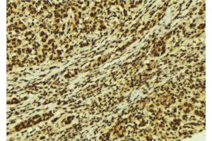 ABIN6274181 at 1/100 staining Human breast cancer tissue by IHC-P. (UBTF Antikörper  (Internal Region))