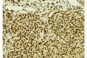 ABIN6274549 at 1/100 staining Human breast cancer tissue by IHC-P. (ZNF148 Antikörper  (N-Term))
