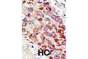 Formalin-fixed and paraffin-embedded human hepatocellular carcinoma tissue reacted with CBLC polyclonal antibody  , which was peroxidase-conjugated to the secondary antibody, followed by AEC staining.