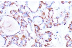 Immunohistochemistry of paraffin-embedded Human thyroid cancer using ISG15 Polyclonal Antibody at dilution of 1:100 (40x lens). (ISG15 Antikörper)