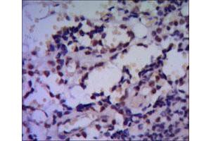 Immunohistochemical analysis of paraffin-embedded human breast cancer using HSPA4 monoclonal antibody, clone 5A6  with DAB staining. (HSPA4 Antikörper)