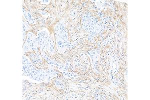 Immunohistochemistry (IHC) image for anti-Fibroblast Activation Protein, alpha (FAP) (AA 26-760) antibody (ABIN7453971) (Rekombinanter FAP Antikörper  (AA 26-760))