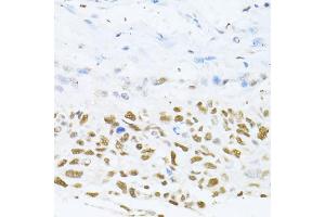 Immunohistochemistry of paraffin-embedded human lung cancer using DNMT1 antibody (ABIN5973205) at dilution of 1/100 (40x lens). (DNMT1 Antikörper)