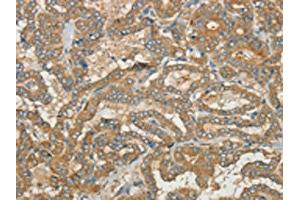 The image on the left is immunohistochemistry of paraffin-embedded Human thyroid cancer tissue using ABIN7190392(CWC27 Antibody) at dilution 1/40, on the right is treated with synthetic peptide. (Cwc27 Antikörper)