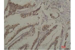 Immunohistochemistry (IHC) analysis of paraffin-embedded Human Breast Carcicnoma using HSC70 Mouse Monoclonal Antibody diluted at 1:200. (Hsc70 Antikörper)