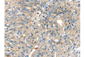The image on the left is immunohistochemistry of paraffin-embedded Human breast cancer tissue using ABIN7192372(SIGLEC8 Antibody) at dilution 1/25, on the right is treated with synthetic peptide. (SIGLEC8 Antikörper)