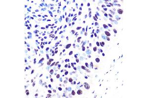 Immunohistochemistry of paraffin-embedded human esophageal cancer using 53BP1 Rabbit mAb (ABIN1679832, ABIN3018199, ABIN3018200 and ABIN7101582) at dilution of 1:100 (40x lens). (TP53BP1 Antikörper)