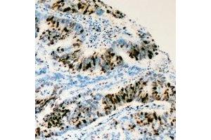Immunohistochemical analysis of RRS1 staining in human colon cancer formalin fixed paraffin embedded tissue section. (RRS1 Antikörper)