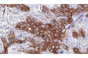 ABIN6277066 at 1/100 staining Human Head and neck cancer tissue by IHC-P.