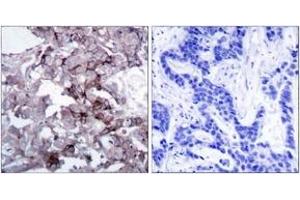 Immunohistochemistry analysis of paraffin-embedded human breast carcinoma tissue, using EGFR (Ab-1172) Antibody. (EGFR Antikörper  (AA 1139-1188))