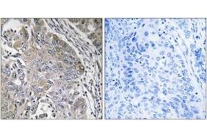 Immunohistochemistry analysis of paraffin-embedded human lung carcinoma, using SPINK6 Antibody. (SPINK6 Antikörper  (AA 13-62))