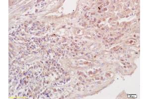 Formalin-fixed and paraffin embedded Human Lung Carcinoma labeled with Anti-Transferrin receptor Polyclonal Antibody, Unconjugated (ABIN734378) at 1:200 followed by conjugation to the secondary antibody and DAB staining (Transferrin Receptor Antikörper  (AA 21-120))