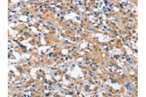 The image is immunohistochemistry of paraffin-embedded human thyroid cancer tissue using ABIN7129101(CUL7 Antibody) at dilution 1/35. (Cullin 7 Antikörper)