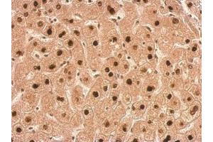 IHC-P Image Transaldolase antibody detects TALDO1 protein at nucleus on human hepatoma by immunohistochemical analysis. (TALDO1 Antikörper  (N-Term))