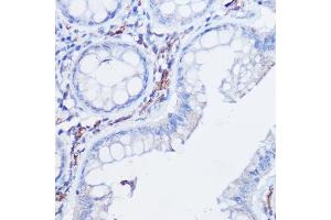 Immunohistochemistry of paraffin-embedded human colon carcinoma using CX3CR1 Rabbit pAb (ABIN3016929, ABIN3016930, ABIN1679440 and ABIN6219885) at dilution of 1:25 (40x lens). (CX3CR1 Antikörper)