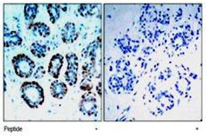 Immunohistochemical analysis of paraffin-embedded human breast carcinoma tissue, using Bsx polyclonal antibody . (BSX Antikörper  (N-Term))