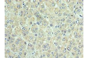 Immunohistochemistry of paraffin-embedded human liver cancer using ABIN7150549 at dilution of 1:100 (DNAJC2 Antikörper  (AA 1-140))