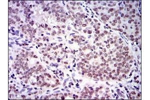 Immunohistochemical analysis of paraffin-embedded cervical cancer tissues using SKP1 mouse mAb with DAB staining. (SKP1 Antikörper)