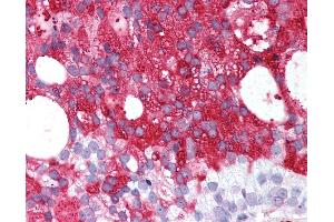 Anti-RXFP1/ LGR7 antibody IHC of human Prostate, Carcinoma. (RXFP1 Antikörper  (C-Term))