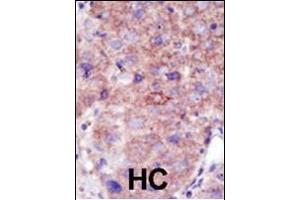 Formalin-fixed and paraffin-embedded human cancer tissue reacted with the primary antibody, which was peroxidase-conjugated to the secondary antibody, followed by DAB staining. (SMURF2 Antikörper  (C-Term))