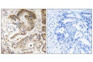 Immunohistochemistry analysis of paraffin-embedded human colon carcinoma tissue using PIK3R5 antibody. (PIK3R5 Antikörper  (C-Term))