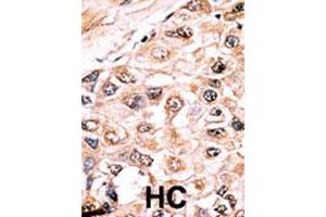Formalin-fixed and paraffin-embedded human hepatocellular carcinoma tissue reacted with ACVR1 polyclonal antibody  , which was peroxidase-conjugated to the secondary antibody, followed by AEC staining. (ACVR1 Antikörper  (Internal Region))