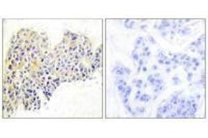 Immunohistochemical analysis of paraffin-embedded human breast carcinoma tissue using HSP90B (Ab-254) antibody. (HSP9AB1 (Ser254) Antikörper)