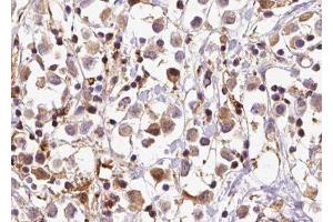 ABIN6279656 at 1/100 staining Human breast cancer tissue by IHC-P.