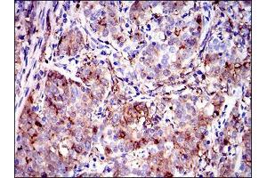 Immunohistochemical analysis of paraffin-embedded cervical cancer tissues using ANXA1 mouse mAb with DAB staining. (Annexin a1 Antikörper  (AA 144-248))
