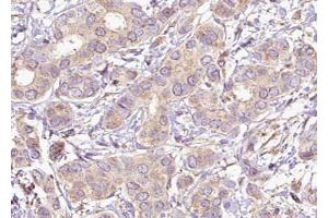 ABIN6267621 at 1/100 staining human Breast carcinoma tissue sections by IHC-P. (PTPN11 Antikörper  (pTyr542))