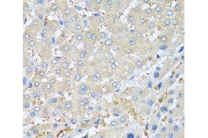 Immunohistochemistry of paraffin-embedded Human liver cancer using PPBP Polyclonal Antibody at dilution of 1:100 (40x lens). (CXCL7 Antikörper)