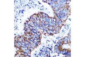 Immunohistochemistry of paraffin-embedded human colon carcinoma using COX IV Rabbit mAb (ABIN7266641) at dilution of 1:100 (40x lens). (COX IV Antikörper)