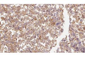 ABIN6278858 at 1/100 staining Human Melanoma tissue by IHC-P. (FGF11 Antikörper  (Internal Region))