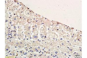 Formalin-fixed and paraffin embedded human hepatitides tissue labeled with Anti-CCR4 Polyclonal Antibody, Unconjugated (ABIN738666) at 1:200 followed by conjugation to the secondary antibody and DAB staining (CCR4 Antikörper  (AA 201-300))