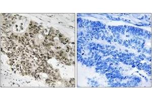 Immunohistochemistry analysis of paraffin-embedded human colon carcinoma, using ATR (Ab-428) Antibody. (ATR Antikörper  (AA 394-443))