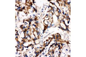 Anti-MEK1 antibody, IHC(P) IHC(P): Human Mammary Cancer Tissue (MEK1 Antikörper  (C-Term))