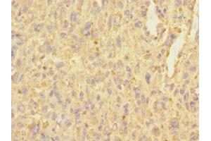 Immunohistochemistry of paraffin-embedded human melanoma using ABIN7174844 at dilution of 1:100