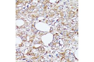 Immunohistochemistry of paraffin-embedded human mammary cancer using SLC7 antibody (ABIN7270481) at dilution of 1:100 (40x lens). (SLC7A2 Antikörper  (C-Term))
